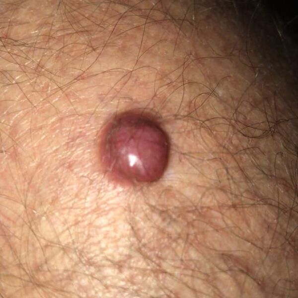 ALEX BAKER - MY MELANOMA STORY