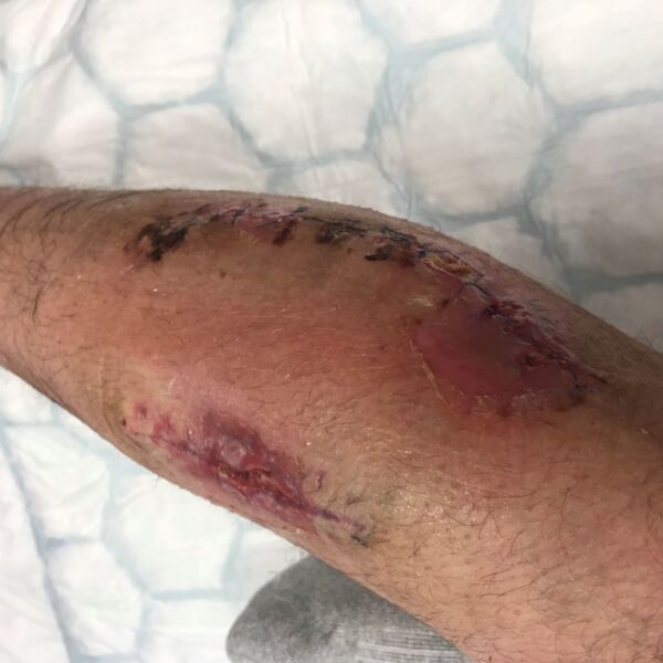 ALEX BAKER - MY MELANOMA STORY