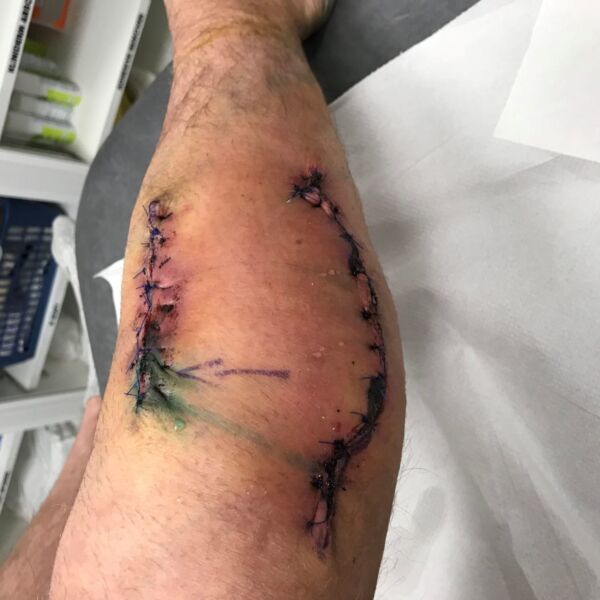 ALEX BAKER - MY MELANOMA STORY