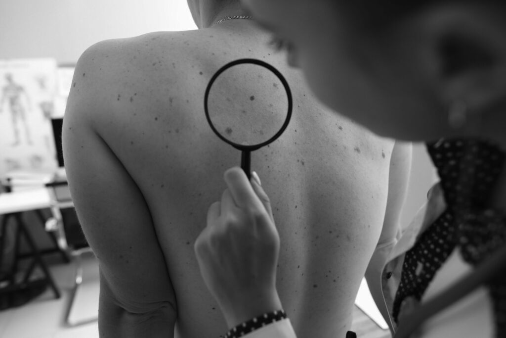 How to Check Your Skin: The ABCDE of Melanoma | Melanoma UK