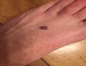 ME MELANOMA, NO CHANCE!