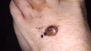 ME MELANOMA, NO CHANCE!