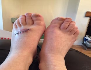 ME MELANOMA, NO CHANCE!
