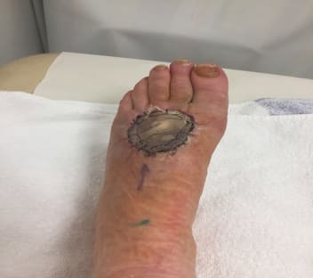 ME MELANOMA, NO CHANCE!