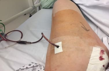 ME MELANOMA, NO CHANCE!