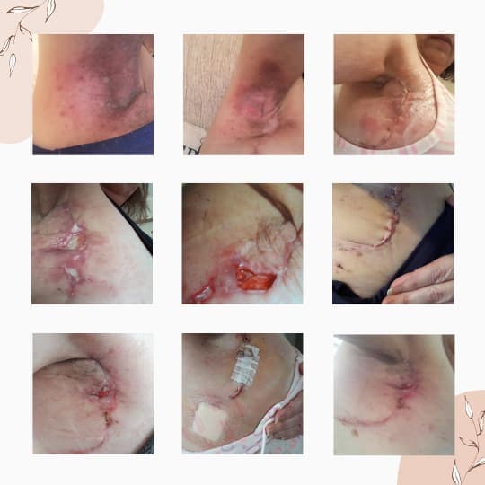 MELANOMA IS NOT ALWAYS SKIN DEEP