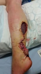 NICKY HORTON - MY MELANOMA STORY