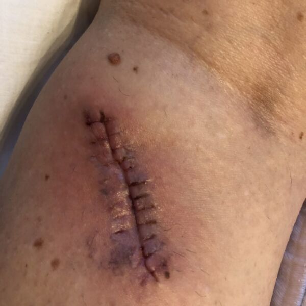 THE BIOPSIES WERE TAKEN AND I WAS ASKED TO TAKE A SEAT!
