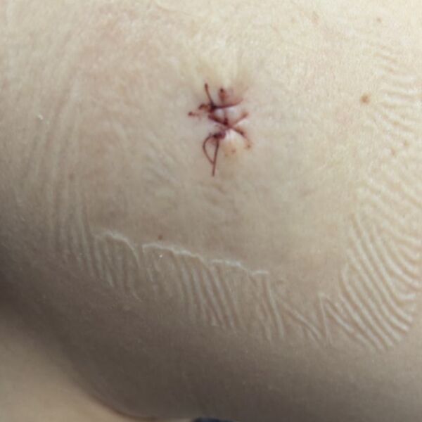 Close-up of a skin mole with stitches indicating post-surgical melanoma removal.