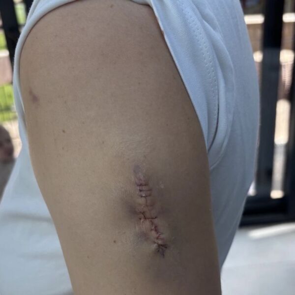 Protective surgical scar on upper arm after melanoma removal, close-up view.