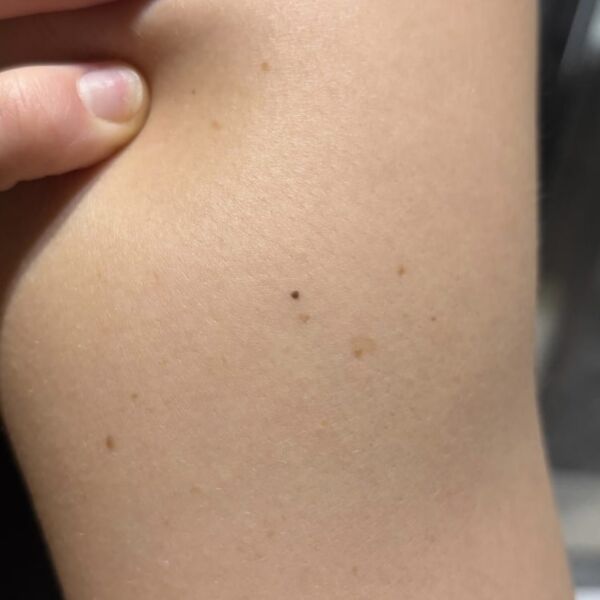 Close-up of skin with mole, melanoma awareness, skin health, skin cancer risk.