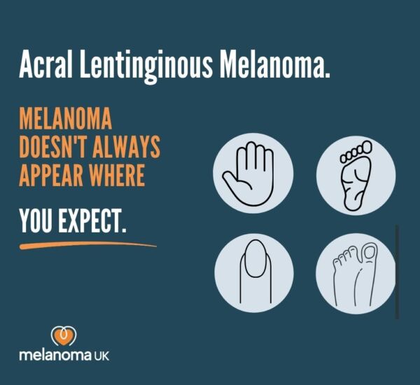 Acral Lentiginous Melanoma awareness infographic with hand, finger, toe, and foot illustrations.